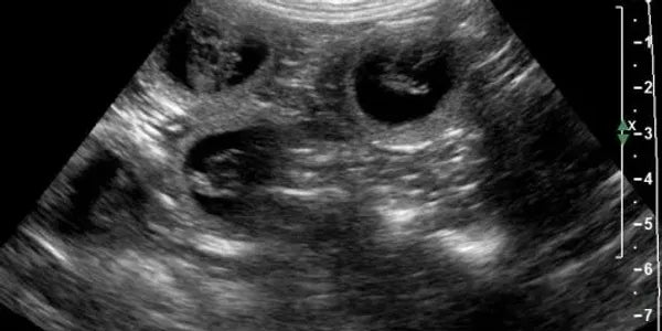Ultrasound pregnancy check