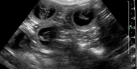 Ultrasound pregnancy check